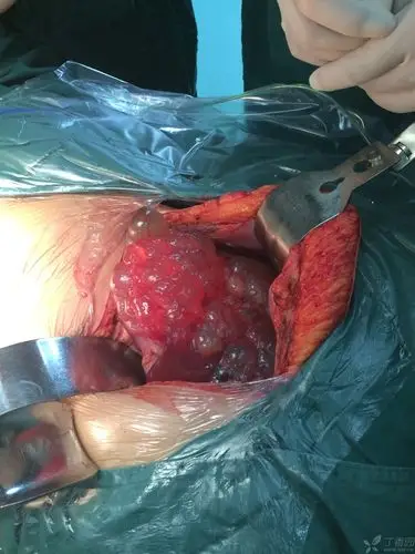 【共享】这么漂亮的肝囊肿,您见过吗?