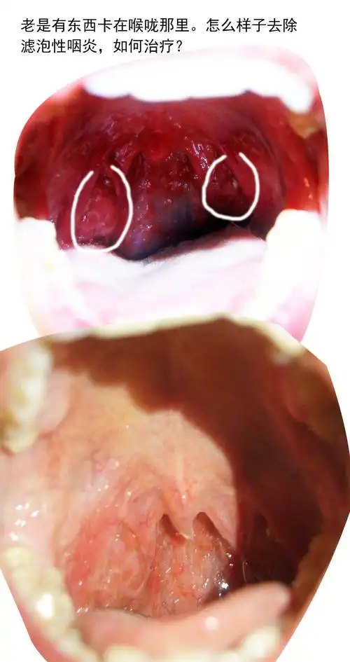 滤泡性咽炎怎么治好?
