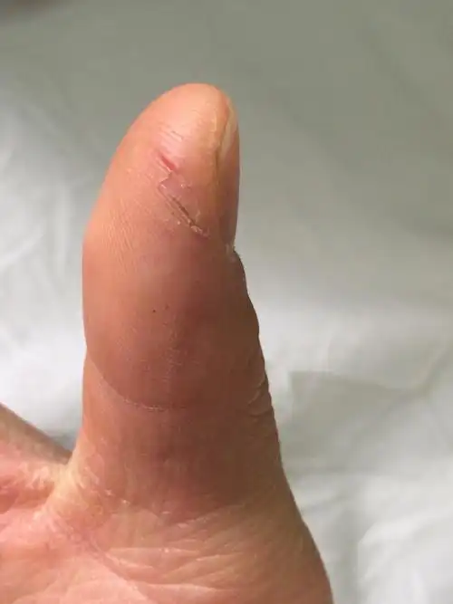 到冬天手上裂很多小口子怎么办?