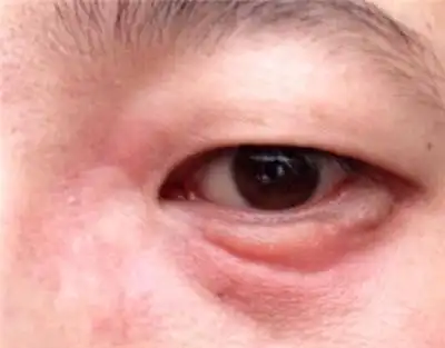 22岁尿毒症患者,依靠透析活命:后悔年少无知,铁打的肾也扛不住