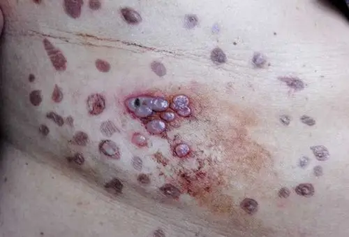 毒疮图片 (20)_有来医生