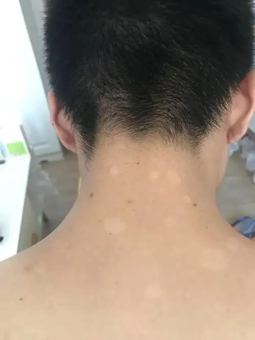 后背皮肤这个样子,这是什么原因