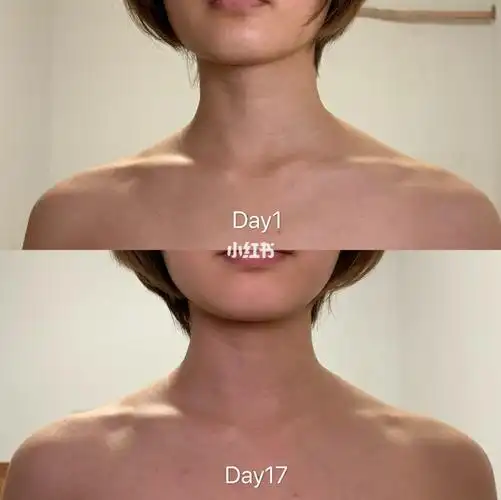 我觉得我的斜方肌是真的很顽强了,目前来说侧面的改善最明显~脖子前倾