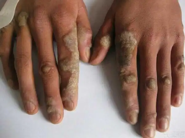 看图说话—x - 皮肤及性传播疾病讨论版 - 爱爱医医学论坛 - 爱爱医