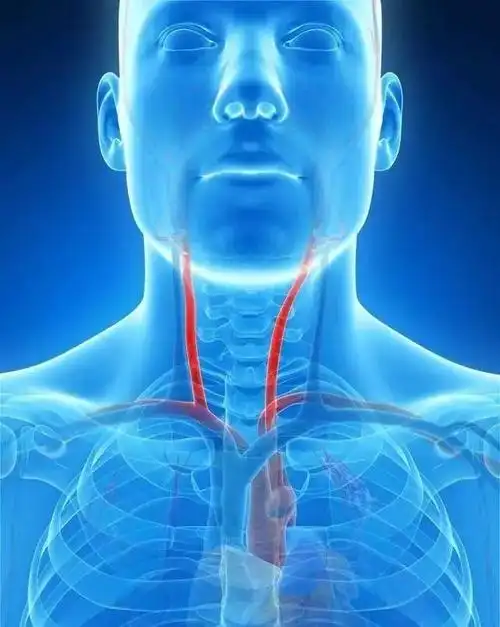 坦然地老去|血管|斑块|血栓|颈动脉_网易订阅