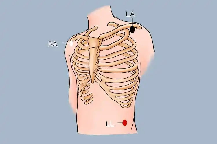 心电监护3个电极位置图及对应颜色_有来医生