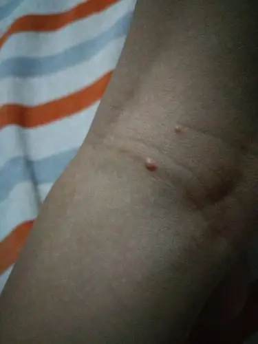 七岁女儿腿窝长的小疙瘩,今天才发现,她说很长时间了,有懂的吗?