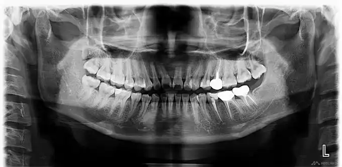 左上前牙根尖周炎一例