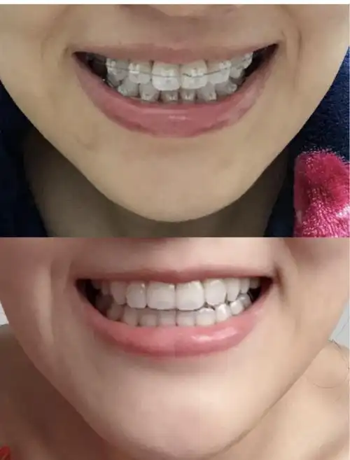 矫正牙齿图片对比照片