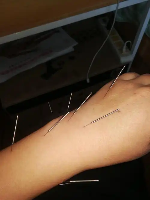 中医小白内针治疗记2脚踝扭伤