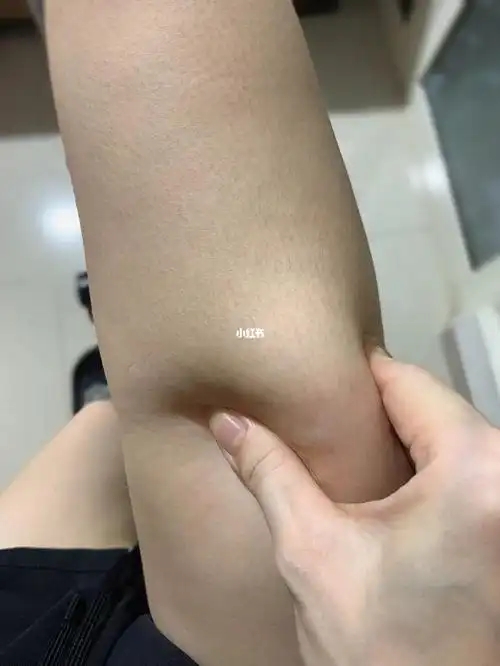 这大腿脂肪多吗