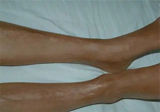 sclerosis,ssc)是一种以小血管功能和结构异常,皮肤,内脏纤维化,免疫