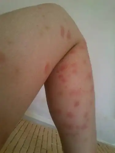 被吸血的臭虫咬了一个晚上起了很多又红又肿的包,很痒,洗了很多次热水