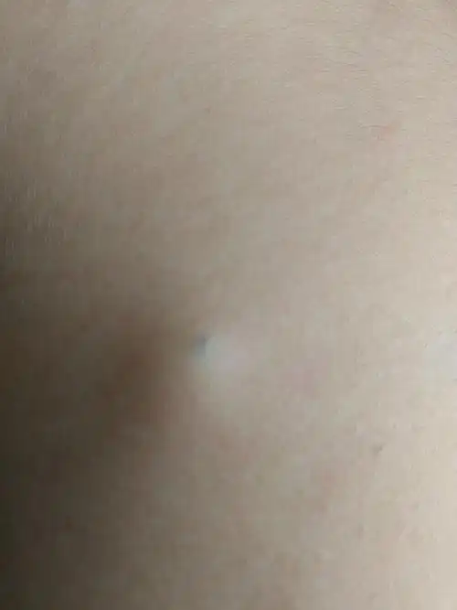 长了一个又大又硬的痘,中间有个黑点,已经长了有一年多了!