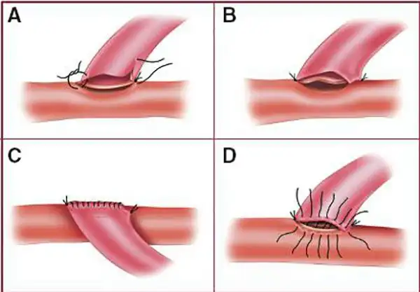 搭桥术中之血管吻合大脑中动脉瘤夹闭