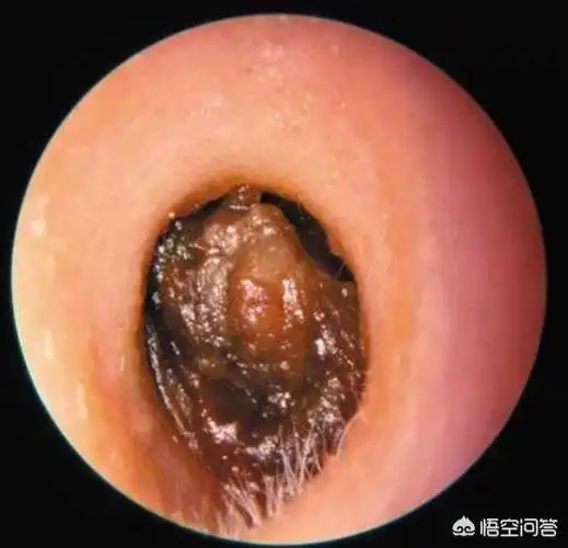 2,耳屎干燥成鳞屑状,片状的,俗称"糠耳",也是正常的外耳道分泌物,无需