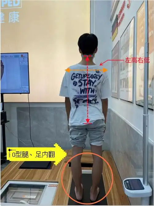 14岁男生o型腿足内翻脊柱侧弯高低肩矫正