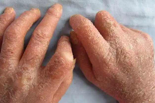 关节型牛皮肤癣症状