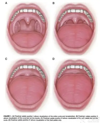 Ⅲ度能看到软腭,看不到悬雍垂 Ⅳ度只能看到硬腭