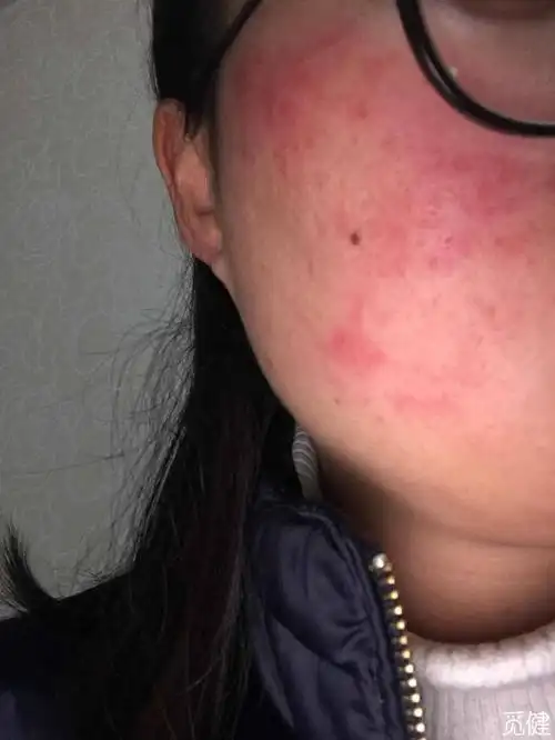 脸上长红斑了,求助