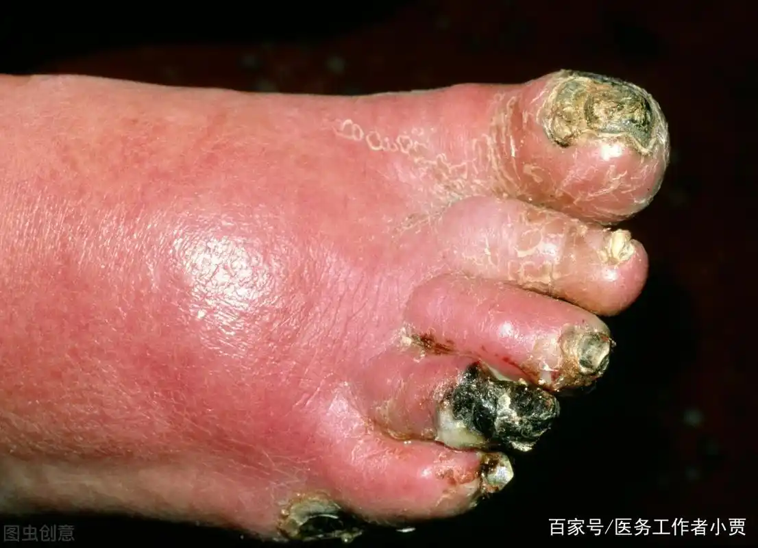 糖尿病足是一种严重的糖尿病并发症,如何正确防治糖尿病足呢?