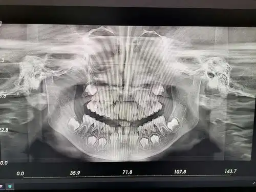 镇安县中医医院口腔ct率先开机啦!