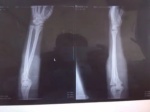 关节上肢关节多发骨折