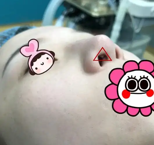 隆鼻后为什么会出现假体外漏