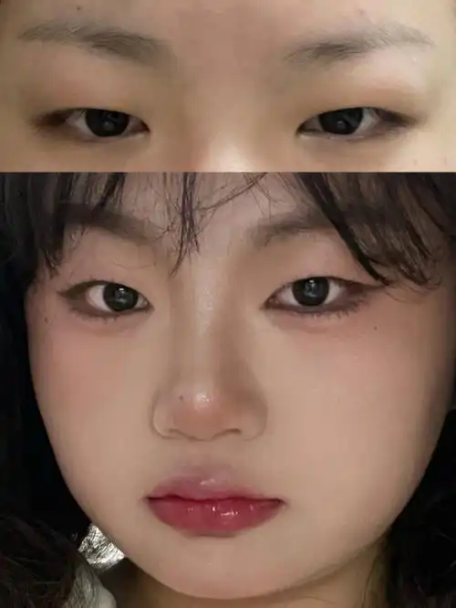 内双肿眼泡爆浆梅子