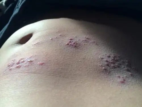 疱疹感染图片 (54)