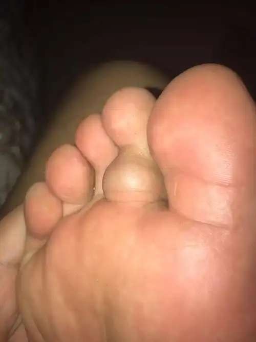 脚趾下方有个包,这是什么,如何治疗?