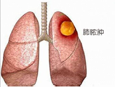 肺脓肿"权威知识"知多少 - 好大夫在线