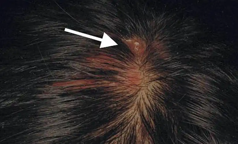 病因具体是什么图片头癣白癣的症状图片头上有头癣不长头发图片头皮癣