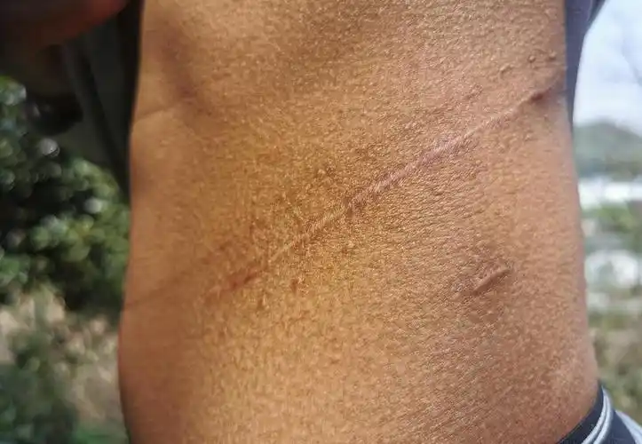 进行了肾脏摘除手术后,李瑞身上留下了一条长约20厘米的刀痕.