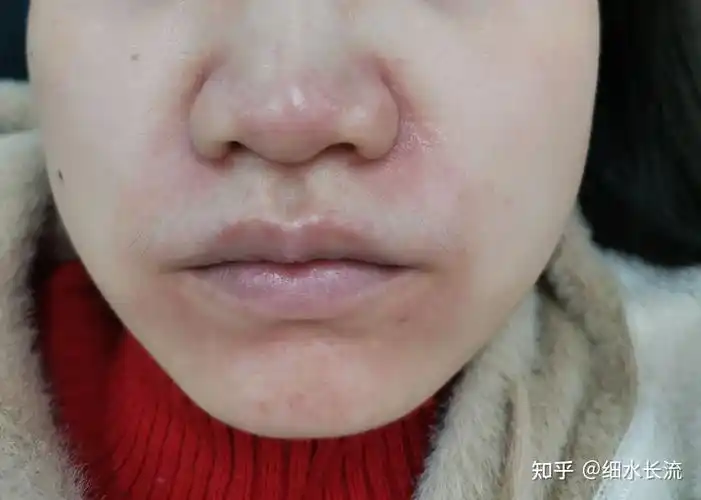 2022年10月22日去广州市皮防所的结果是玫瑰痤疮(酒糟鼻)心好累,每看