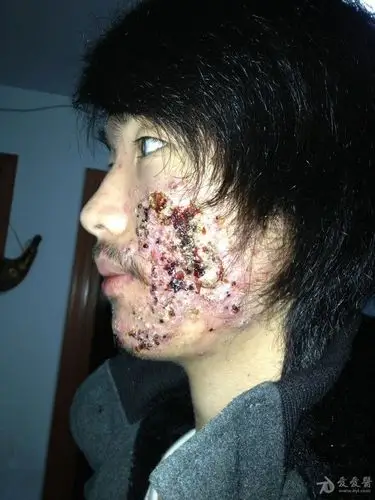 请教顽固性座疮如何治疗好,有图有真相