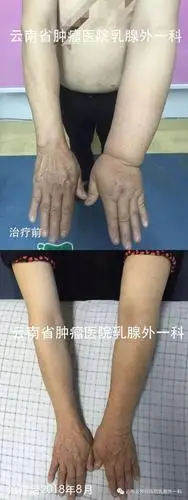 健康科普 |上肢淋巴水肿的预防和治疗