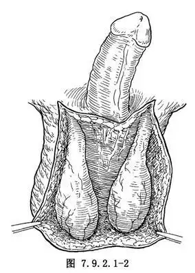 阴囊成形术_阴囊及其内容物手术,手术,泌尿外科手术,阴囊丝虫病的手术