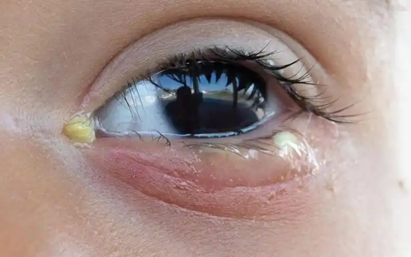 婴儿泪囊堵塞可进行局部按摩