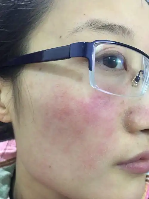 面部湿疹患病10个多月