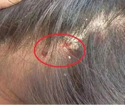 头皮上老是长痘痘,扣了是个血痂要不然就是按着疼的包,这是啥玩意啊?