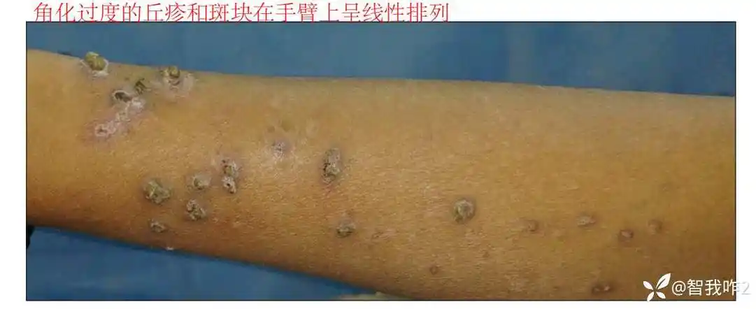 经典病例学习线性排列的丘疹