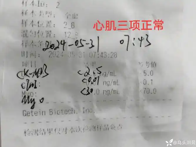 急性下壁心梗心电图变化