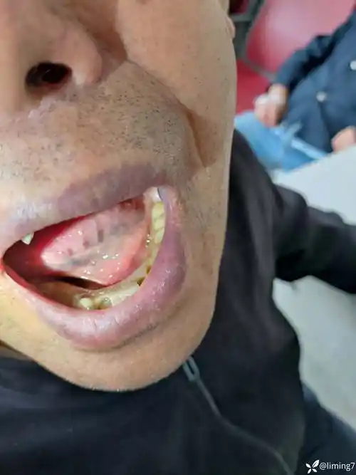 患者男82岁左舌下肿块二个月