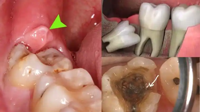 的症状常常会由于智齿萌出不完全,牙冠的一部分被牙龈包绕,形成盲袋