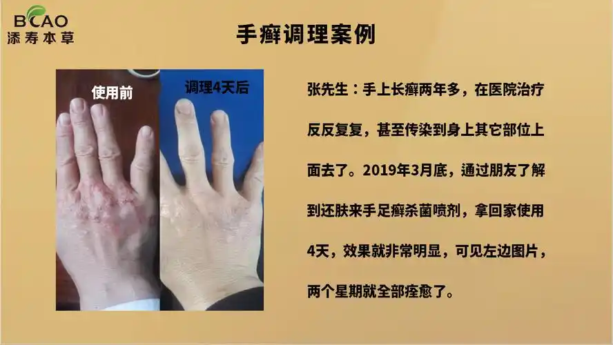 手癣调理案例1.jpg