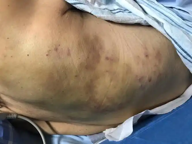 一例皮下瘀斑引起的思考