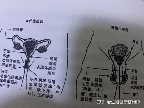 女性生殖道感染包括以下4项1,外阴,阴唇,阴道感染如生殖器溃疡(梅毒