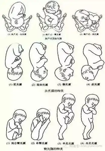 了解胎位不正为分娩做好准备