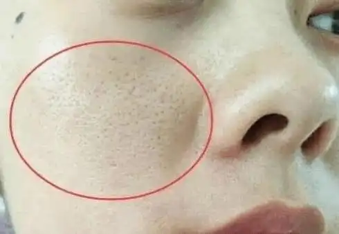 孩子脸上毛囊堵塞怎么办